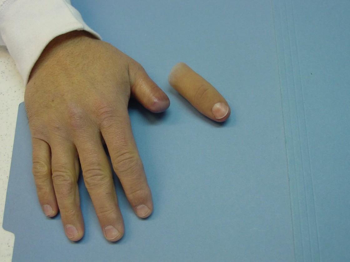 Expert Care for Aesthetic and Functional Recovery in Ranchi and East India